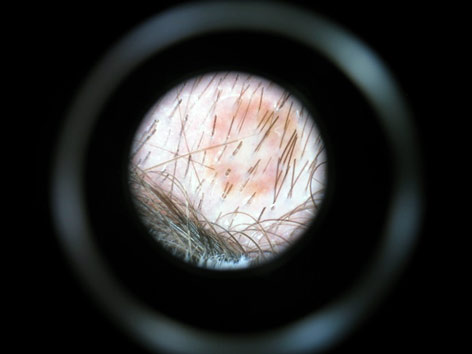 alunita imagine dermatoscopica centru cromatica reducainel brun