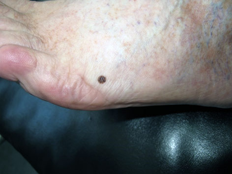 melanom picior imagine macroscopica leziune pigmentata contur regulat