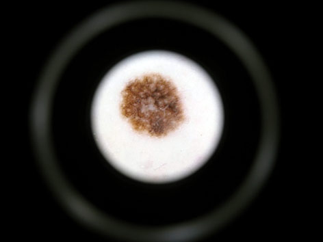 melanom culori imagine dermatoscopica melanom subtire