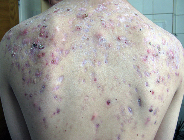 acnee pe spate conglobata cu supuratie severa - tratament roaccutane
