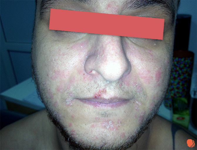 dermatita seboreica faciala extinsa barbie nas mustata