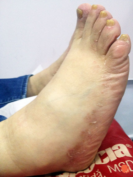 tinea pedis - ciuperca picior - tratament dermatologie Mivaderm