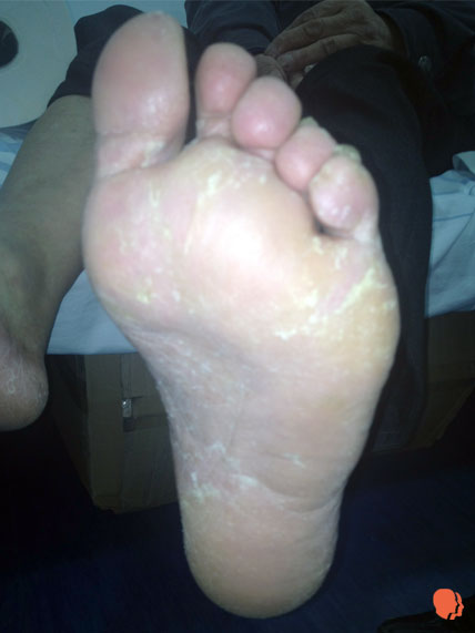 tratamentul ciupercii degetelor de la picioare