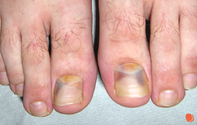 hemoragie subunghiala - picioare - dermatologie - mivaderm