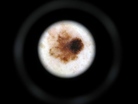 melanom imagine dermatoscopica asimetrie pigmentatie accentuata