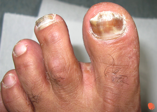 Malavit și ciuperca unghiilor de la picioare