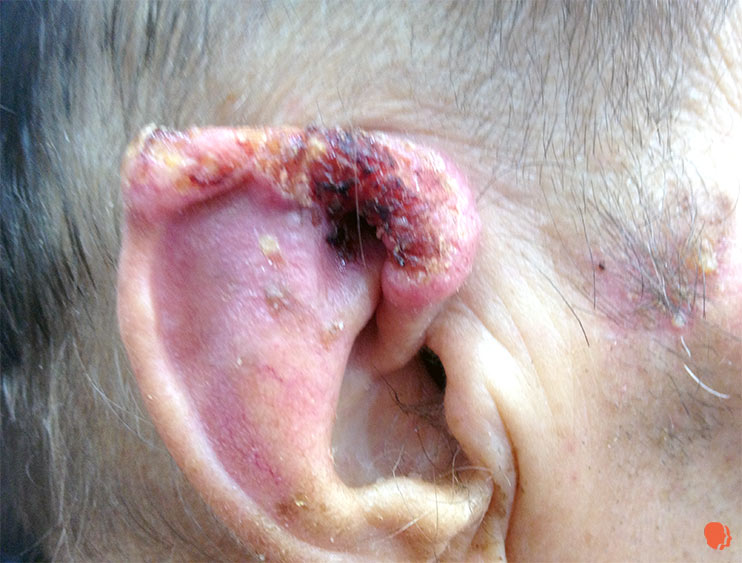 Carcinom bazocelular distrugere. Cancerul de piele. Dr dermatologie Virginia Chitu