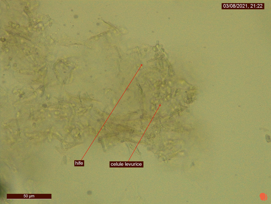 Pitiriazisul versicolor. Imagine examen micologic microsccopic. 